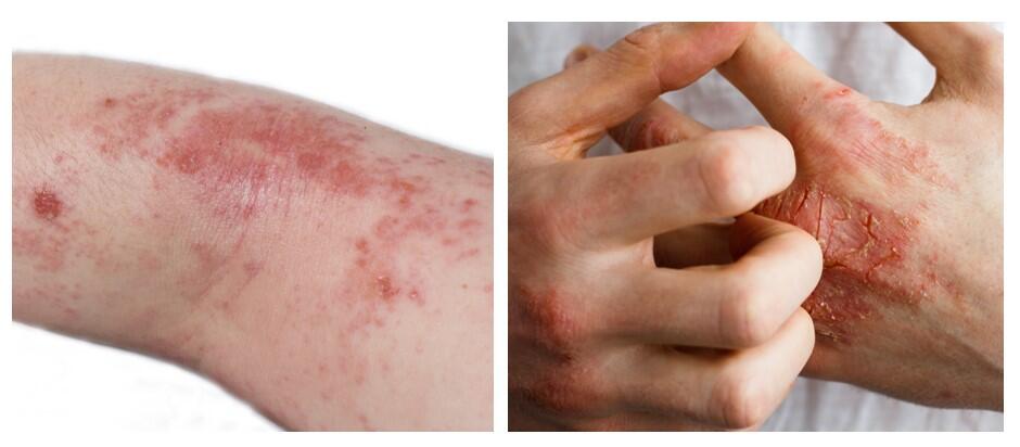 tipo di eczema